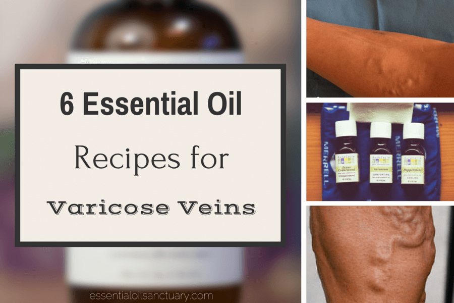 6 Essential Oils for varicose veins