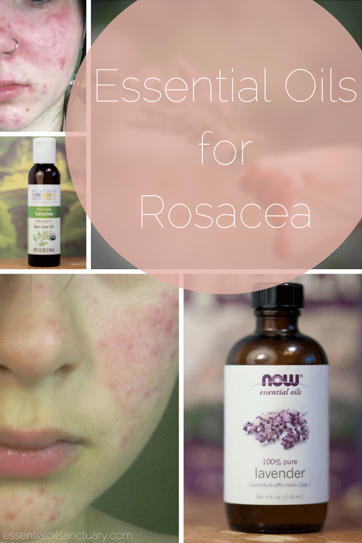 Essential oils for rosacea