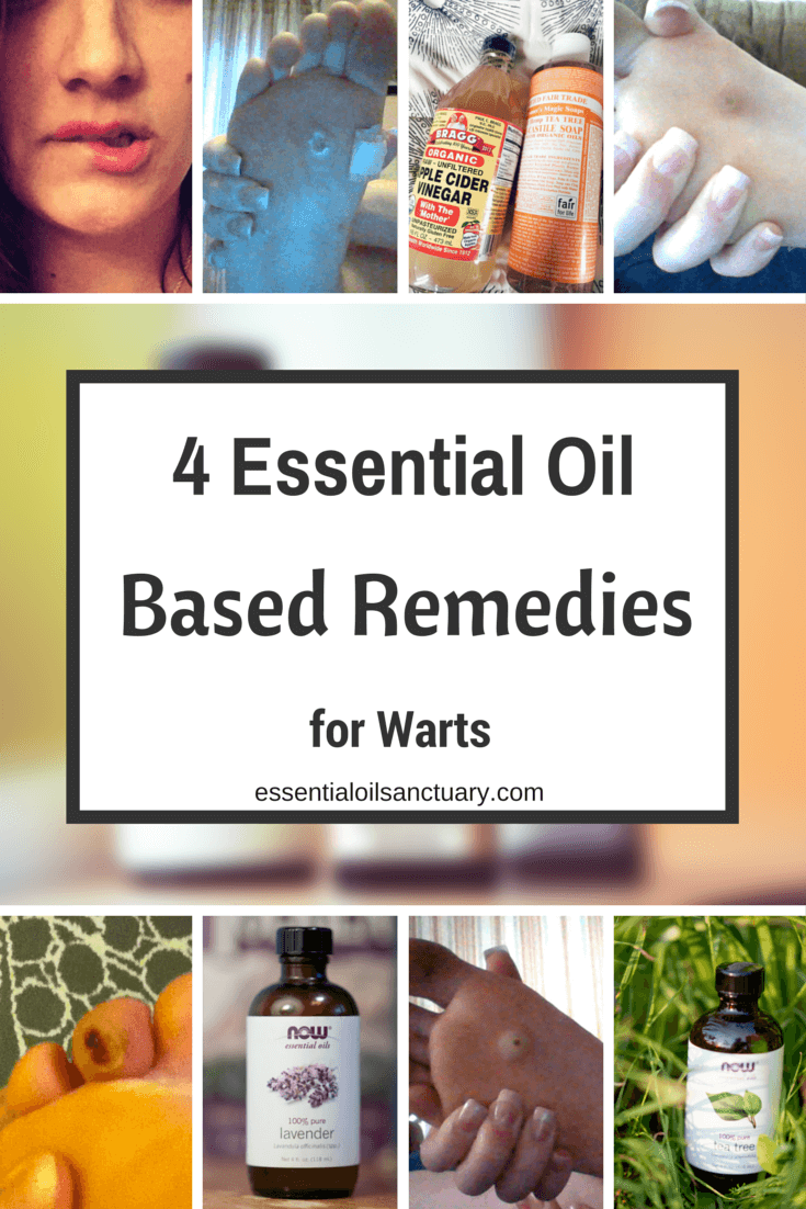 4 Essential Oil based remedies for warts