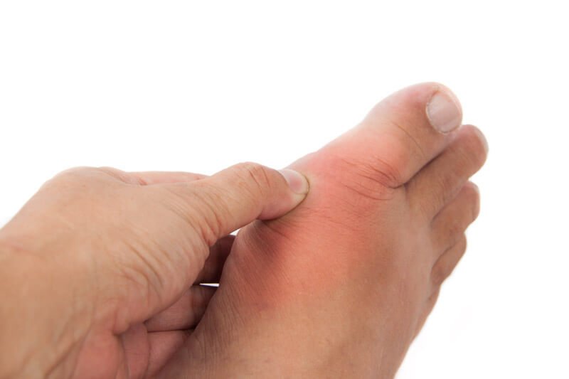 gout sore foot