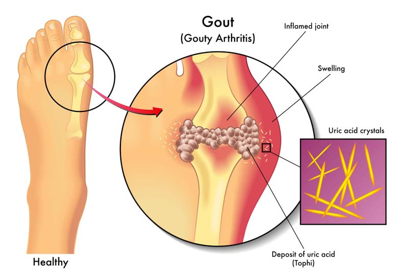 gouty arthritis
