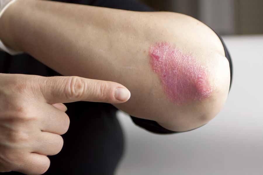 eczema sporiasis dry skin